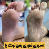 اسپری ترک پا راکو لایه بردار و جوانسازی پا