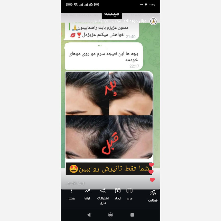 ویال مو(تقویت و رشد مجدد مو)کاملا گیاهی و فاقد ماینوکسیدیل